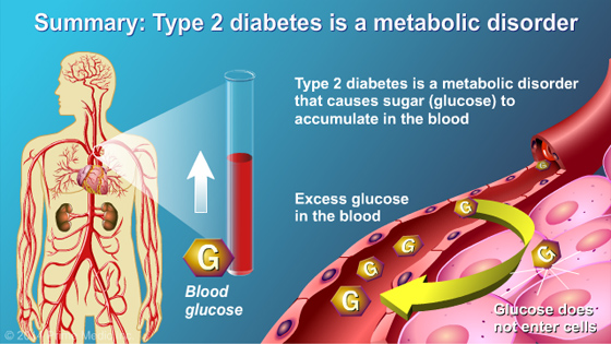 Understanding Type 2 Diabetes - Slide Show - 19