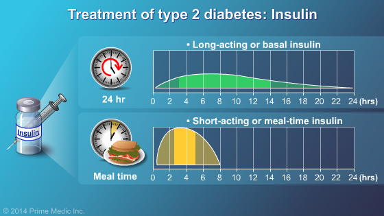Management and Treatment of Type 2 Diabetes - Slide Show - 21