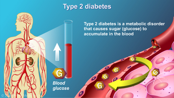 Understanding Type 2 Diabetes - Slide Show - 3