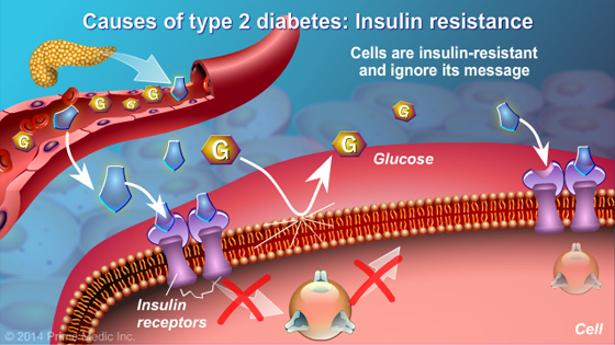 Understanding Type 2 Diabetes - Slide Show - 9
