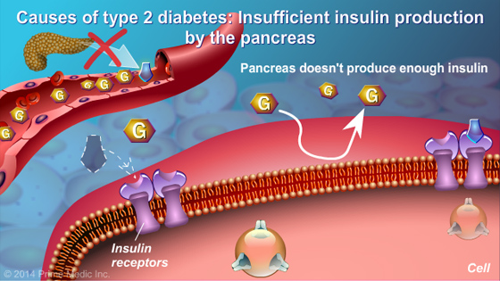 Understanding Type 2 Diabetes - Slide Show - 10