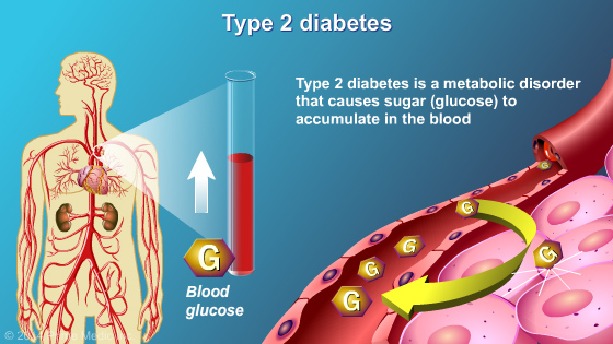 Diagnosis of Type 2 Diabetes - Slide Show - 3