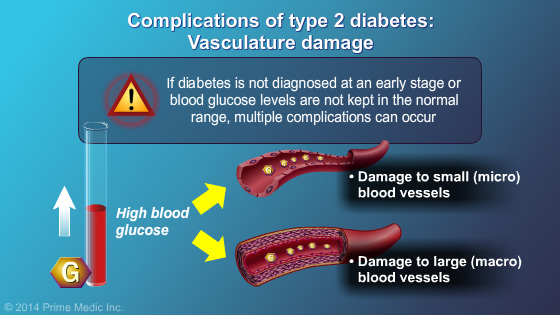 Diagnosis of Type 2 Diabetes - Slide Show - 9