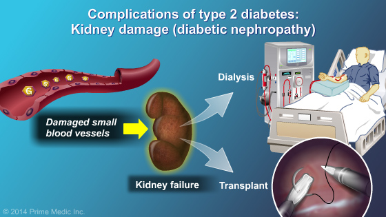 Diagnosis of Type 2 Diabetes - Slide Show - 11