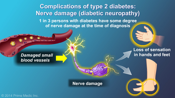 Diagnosis of Type 2 Diabetes - Slide Show - 12