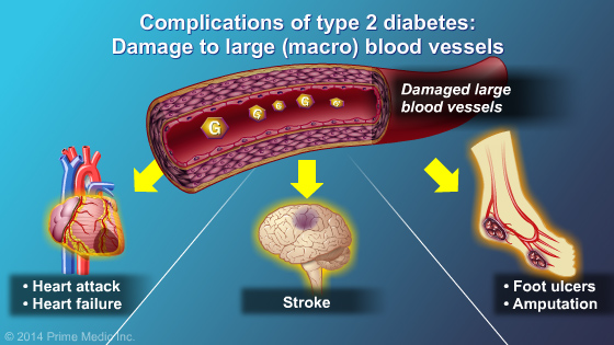 Diagnosis of Type 2 Diabetes - Slide Show - 13
