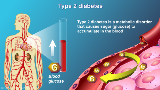 Management and Treatment of Type 2 Diabetes - Slide Show - 3